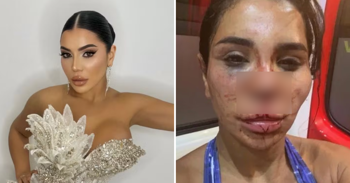 influenciadora-francesa-fica-desconfigurada-apos-sofrer-ataque-brutal-por-homens-armados