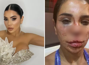 influenciadora-francesa-fica-desconfigurada-apos-sofrer-ataque-brutal-por-homens-armados